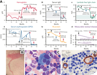 Multinucleated plasma cells and IgG λ myeloma in a patient with TEMPI syndrome and renal cell carcinoma
