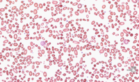 Peripheral Blood Smear Findings in Hereditary Pyropoikilocytosis