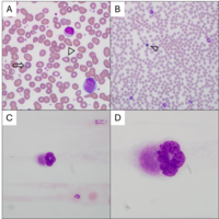 Circulating Megakaryocyte in Post-ET Myelofibrosis