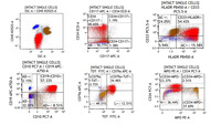 B-ALL with ETV6::RUNX1 fusion: flow cytometry