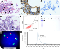Albumin-derived pseudo-Dutcher bodies in nonsecretory myeloma