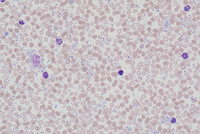 Extreme thrombocytosis in CML