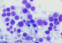 MPN blast phase with AEL morphology, BMA