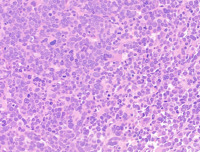 MPN blast phase with AEL morphology, BMT H&E