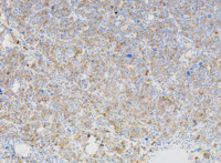 MPN blast phase with AEL morphology, BMT CD71
