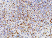 MPN blast phase with AEL morphology, BMT E-cadherin