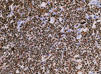 MPN blast phase with AEL morphology, BMT TP53