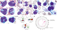 Therapy-related AML with MECOM rearrangement, biallelic TP53 inactivation, and striking nuclear abnormalities