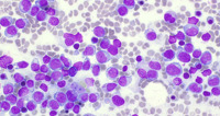 AML with biallelic CEBPA mutation with biZIP: BMA