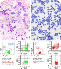 CNS relapse during menin inhibitor therapy