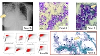 Pleural Fluid Blasts in Extramedullary Acute Myeloid Leukemia
