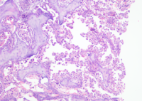 Bone marrow metastasis from lung Adenocarcinoma