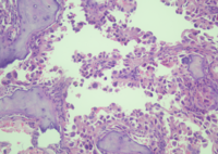 Bone marrow metastasis from lung Adenocarcinoma 1