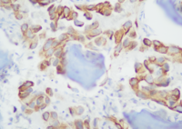 Bone marrow metastasis from lung Adenocarcinoma 2