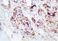 Bone marrow metastasis from lung Adenocarcinoma 3