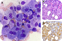 Crumpled cytoplasm, clear diagnosis: the iconic morphology of Gaucher disease