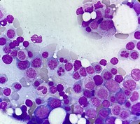 Figure 2: Leishman–Giemsa-stained bone marrow aspirate smear demonstrates prominent dyserythropoiesis