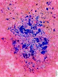 Figure 2: Bone marrow aspirate smears showing numerous hemosiderin-laden macrophages with coarse blue granules, consistent with Grade 6 iron stores (