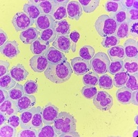 Plasmocyte Neoplasms - extramedullary disease.