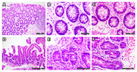 Not Every Apoptotic Crypt Is GVHD: Astrovirus Enterocolitis After Allogeneic HCT