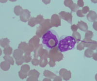 Erythrophagocytosis by neoplastic cells in HSTCL