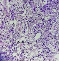 ALK-Positive Anaplastic Large Cell Lymphoma with bone marrow involvement.