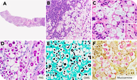 Disseminated cryptococcal lymphadenitis mimicking lymphoma and masked by prozone effect