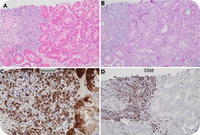 Lysozyme-associated nephropathy heralding leukemic transformation in myelofibrosis