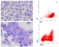 NPM1-mutated AML: CSF infiltration