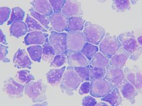AML with mutated NPM1 1