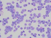 AML with mutated NPM1 2