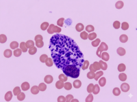 macrophage containing numerous intracellular Leishman-Donovan (LD) bodies (amastigotes).