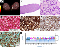 Blasting into muscle: isolated BPDCN relapse with second TP53 hit