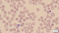 Stomatocytosis and Macrothrombocytes in Hereditary Sitosterolemia