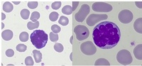 ATLL blood film
