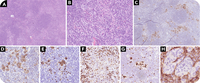 Classic Hodgkin lymphoma showing interfollicular and intrasinusoidal involvement