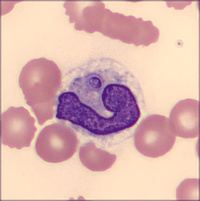 Intracellular Histoplasma in Peripheral Blood in Disseminated Histoplasmosis 1