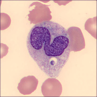 Intracellular Histoplasma in Peripheral Blood in Disseminated Histoplasmosis 2
