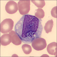 Intracellular Histoplasma in Peripheral Blood in Disseminated Histoplasmosis 3