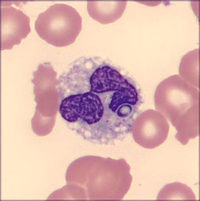Intracellular Histoplasma in Peripheral Blood in Disseminated Histoplasmosis 4