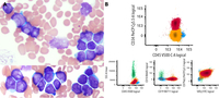 Cuplike nuclei and bimodal CD34 expression in adult KMT2A-rearranged pro-B acute lymphoblastic leukemia