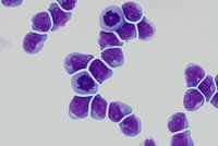Lymphoma - CSF