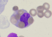 Hemophagocytic Lymphohistiocytosis