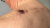 BPDCN-skin lesions