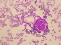 An Unusual Visitor in the Blood: Microfilaria in a Child with Pancytopenia-Cause or Incidental Finding?