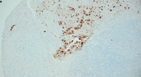 HSV IHC