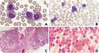NPM1-mutated myeloid neoplasm presenting as chronic eosinophilic leukemia