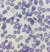 Schistocyte