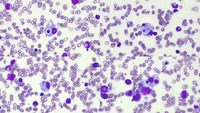 Primary HLH