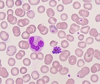 Mature schizont of Plasmodium vivax in peripheral blood 1